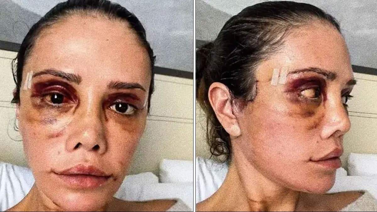 İkinci yüz nakli sonrası felç geçiren Didem Ceran'dan yeni adım