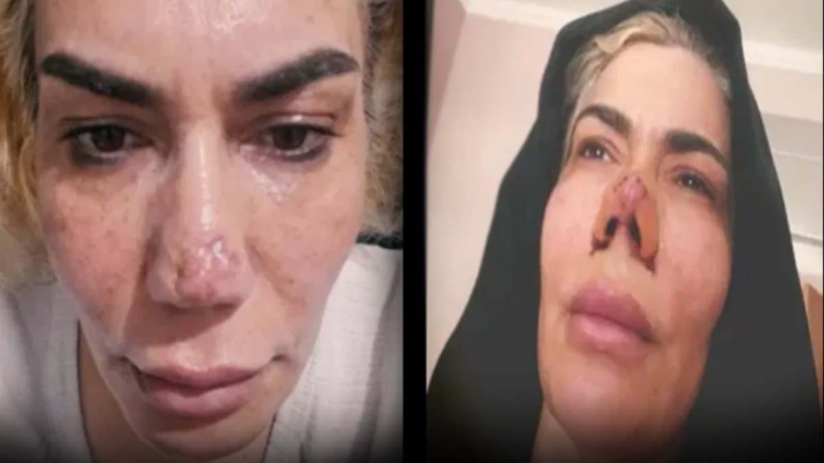 Estetik operasyonunda korkutan sonuç: Burnu yırtıldı